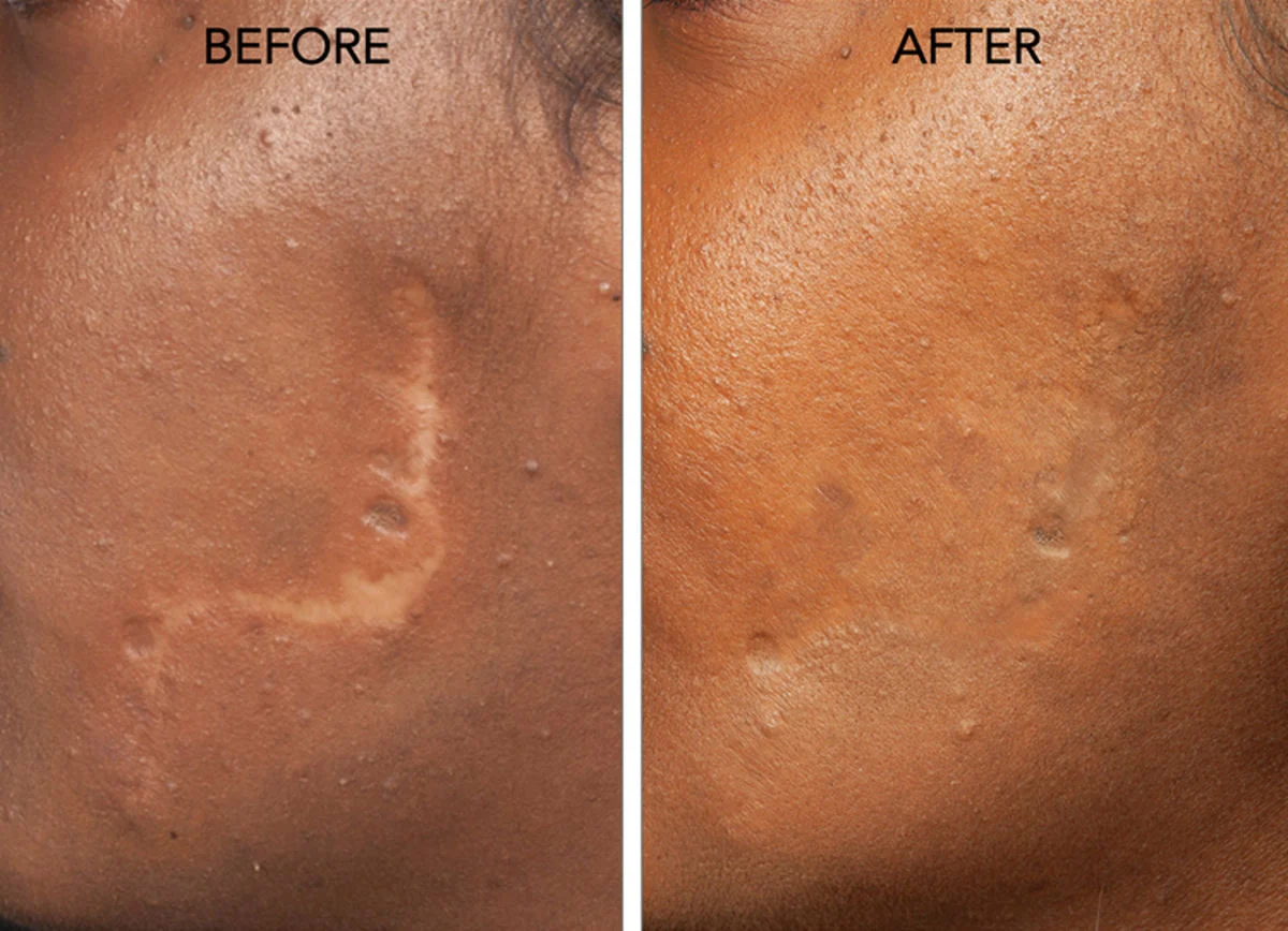 مقایسه درمان جای زخم با سلولهای بنیادی و لیزر؛ کدام مؤثرتر است؟ مقایسه درمان جای زخم با سلولهای بنیادی و لیزر؛ کدام مؤثرتر است؟