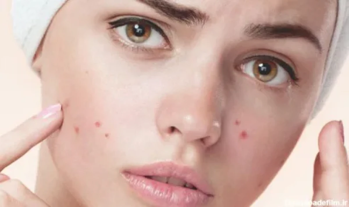 از بین بردن لک پوست؛ روش‌های علمی که واقعاً جواب می‌دهند